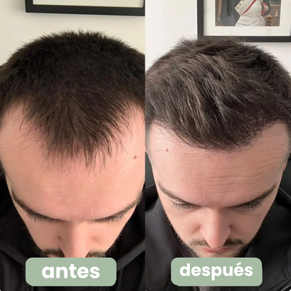 Bornin™ - Suero para el crecimiento del cabello