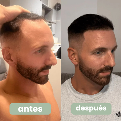 Bornin™ - Suero para el crecimiento del cabello